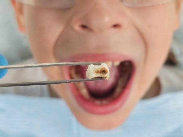 Best Emergency Treatment for Dental Infections or Abscesses in Duncan, OK